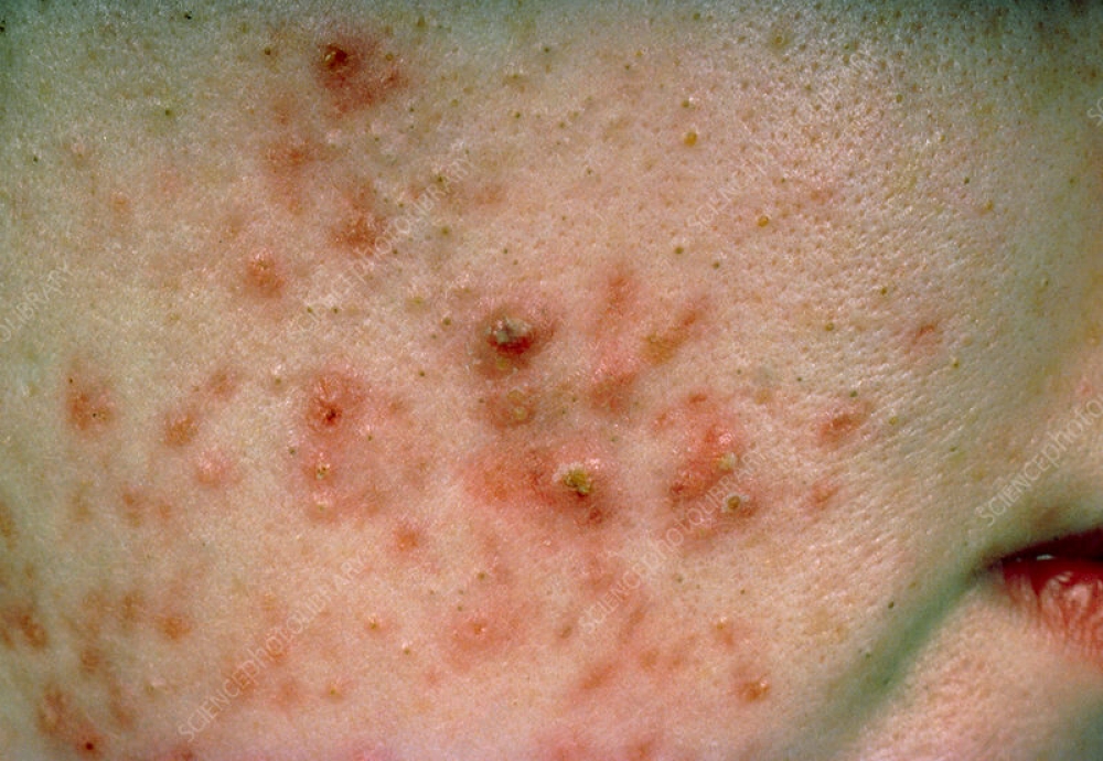 Pimple pop my  blackheads