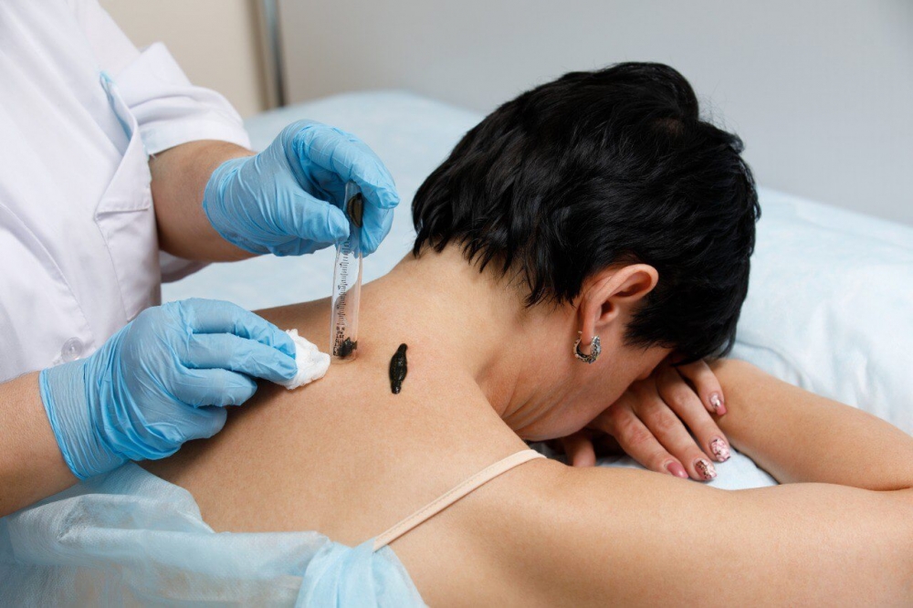 Medicinal Leech Therapy - hirudotherapy